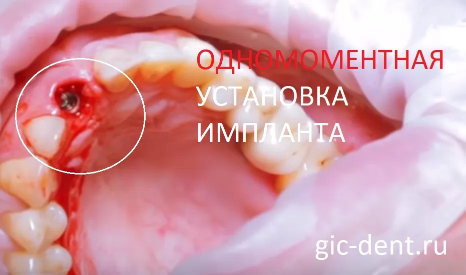 Одномоментная установка импланта после удаления зуба
